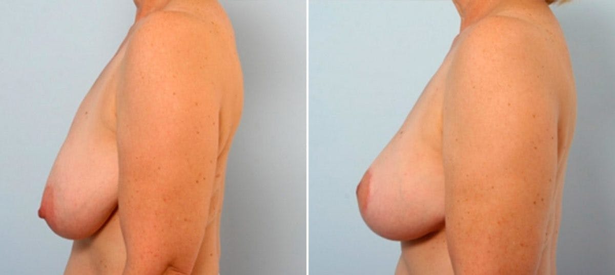 Breast Lift Before & After Photo - Patient 55078855 - Image 5