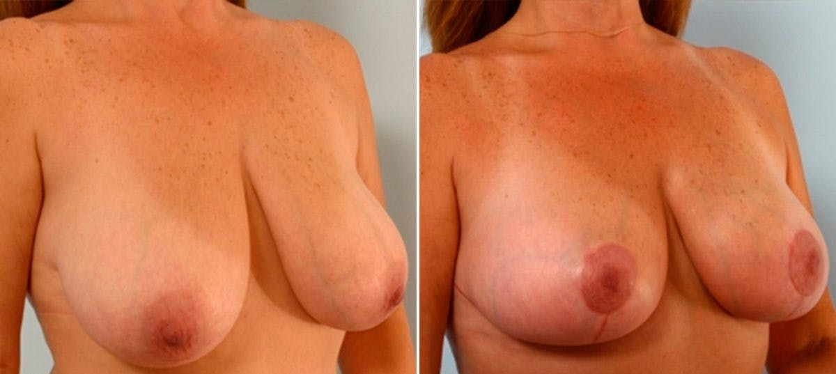 Breast Lift Before & After Photo - Patient 55078856 - Image 2
