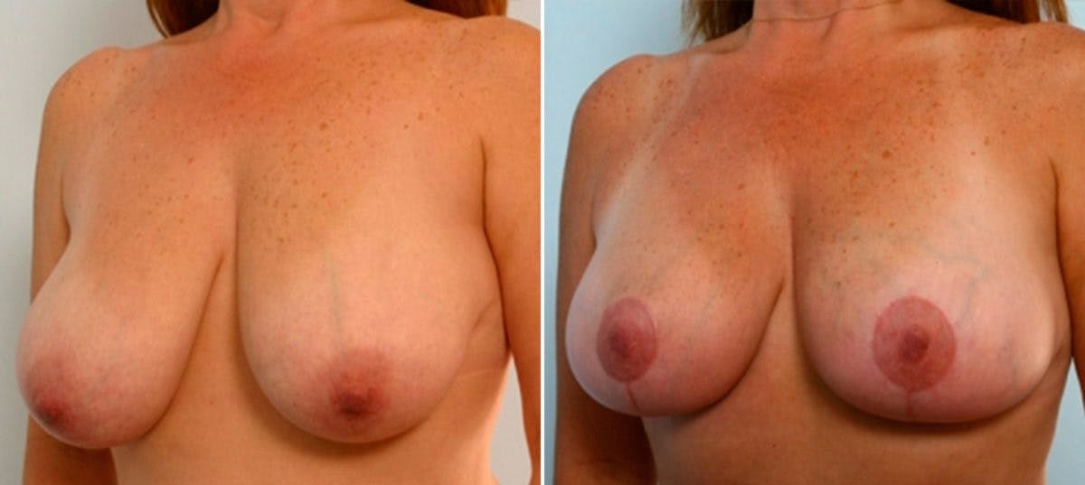 Breast Lift Before & After Photo - Patient 55078856 - Image 3
