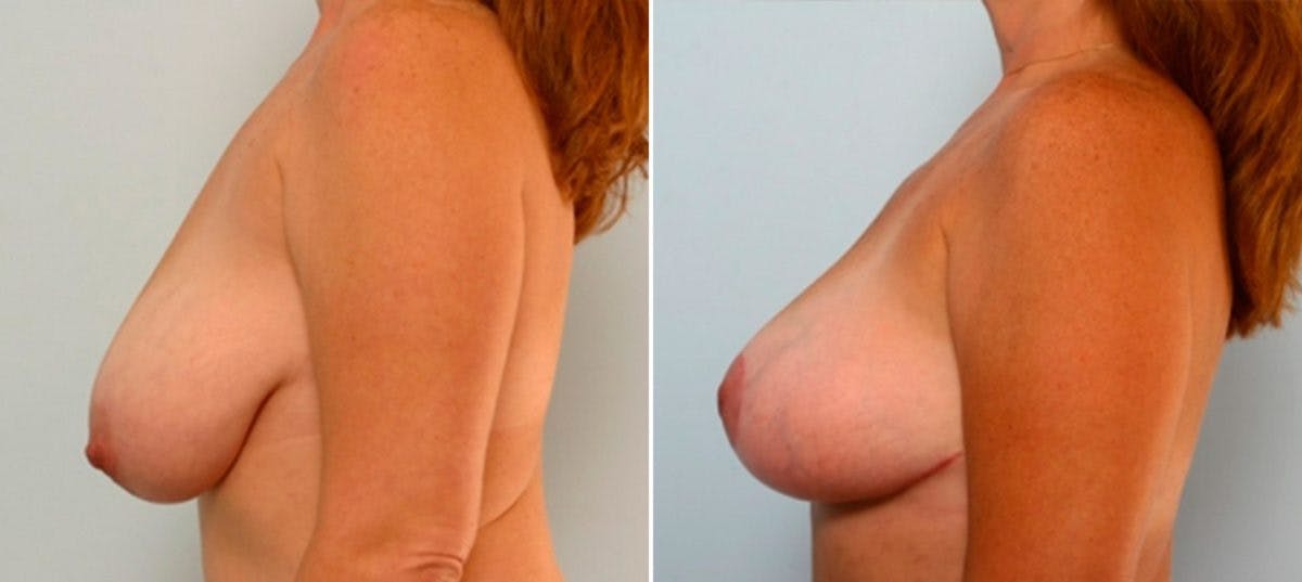 Breast Lift Before & After Gallery - Patient 55078856 - Image 4