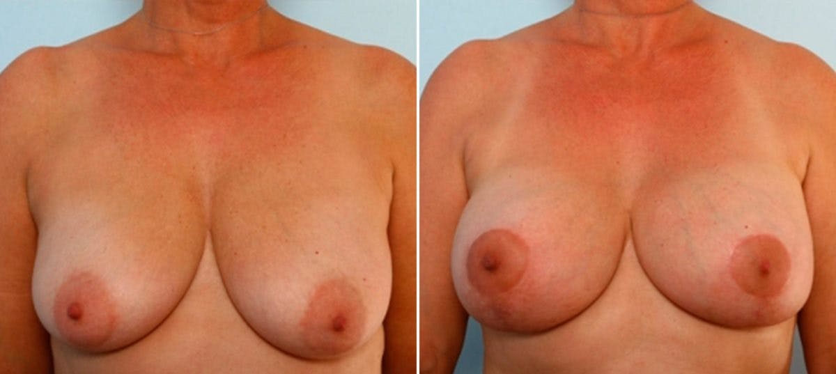 Breast Lift with Augmentation Before & After Gallery - Patient 55485018 - Image 1