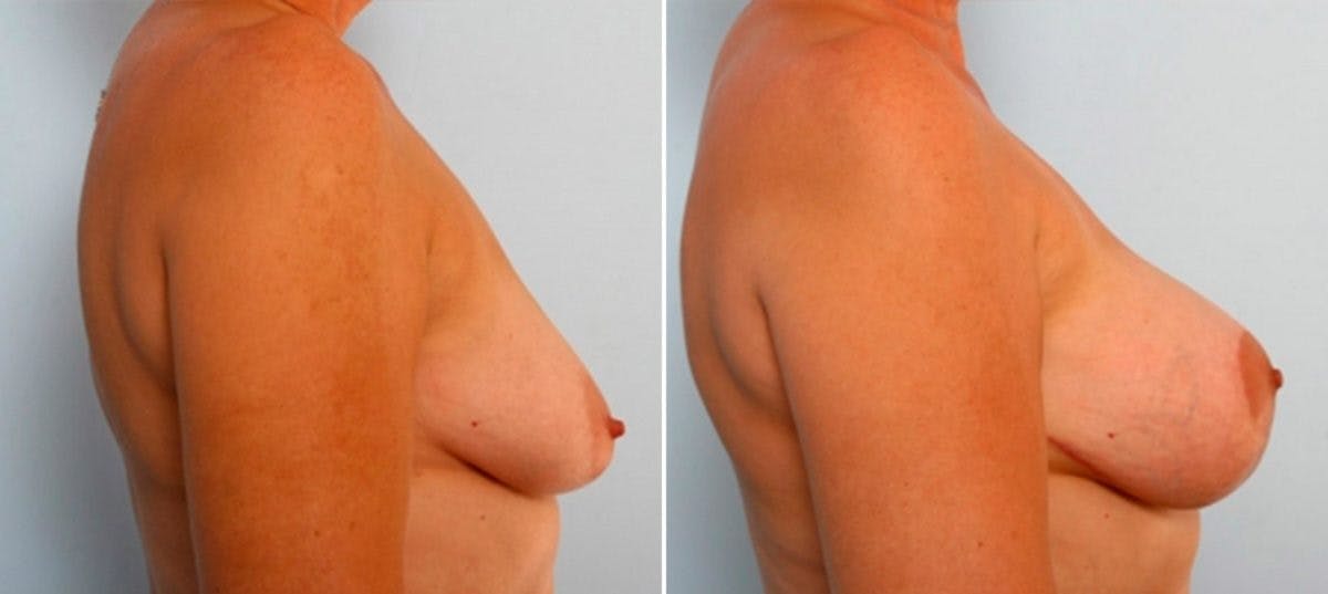 Breast Lift with Augmentation Before & After Gallery - Patient 55485018 - Image 2