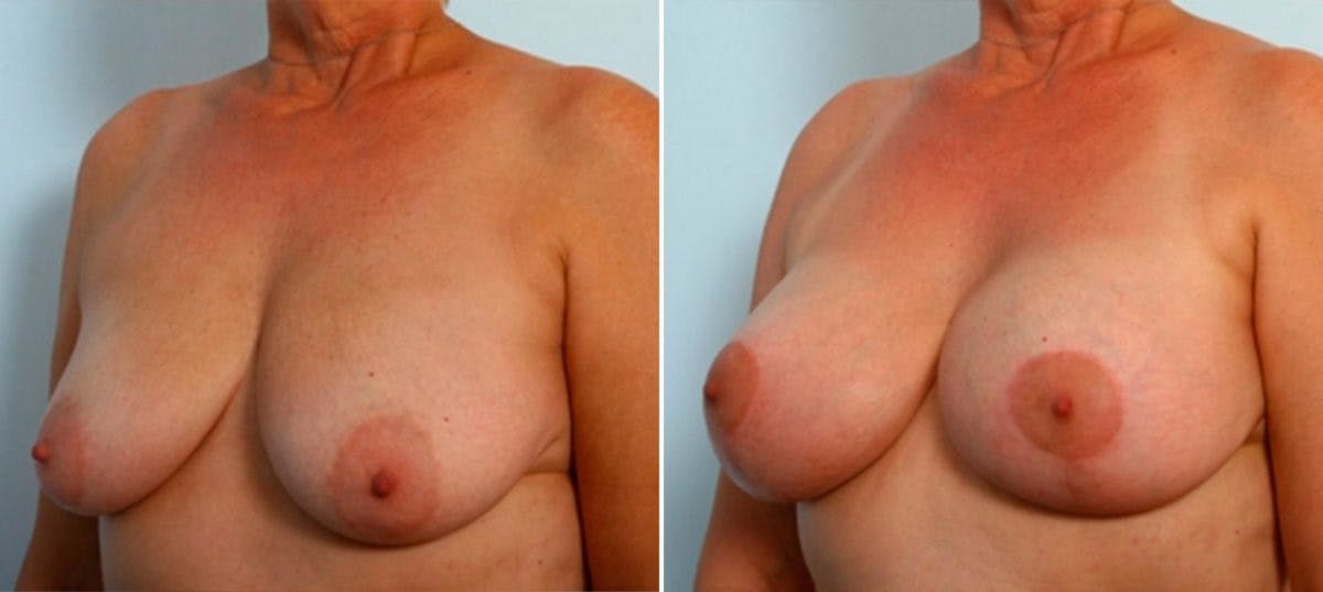 Breast Lift with Augmentation Before & After Gallery - Patient 55485018 - Image 3