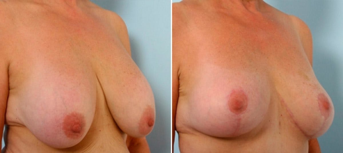 Breast Lift with Augmentation Before & After Gallery - Patient 55485019 - Image 2