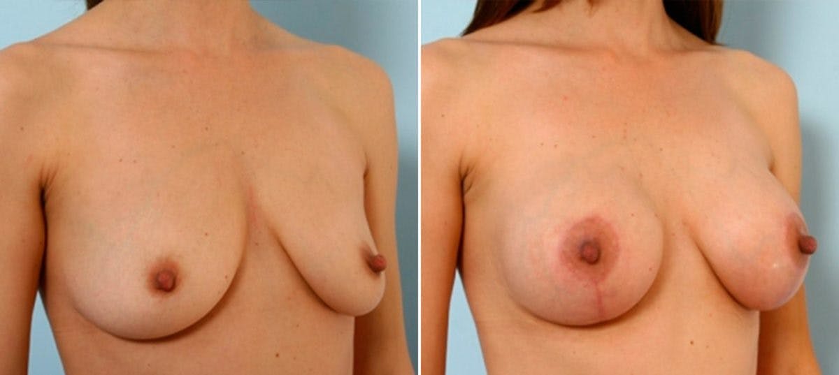 Breast Lift with Augmentation Before & After Gallery - Patient 55485020 - Image 2