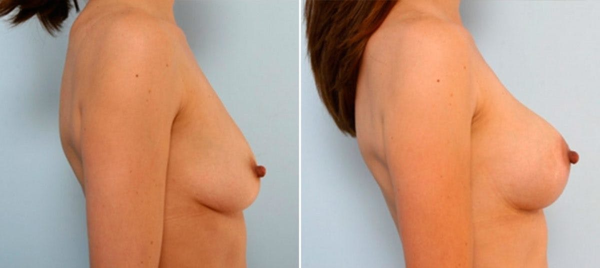 Breast Lift with Augmentation Before & After Gallery - Patient 55485020 - Image 3