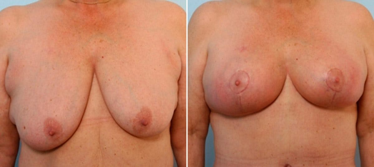 Breast Lift with Augmentation Before & After Gallery - Patient 55485021 - Image 1