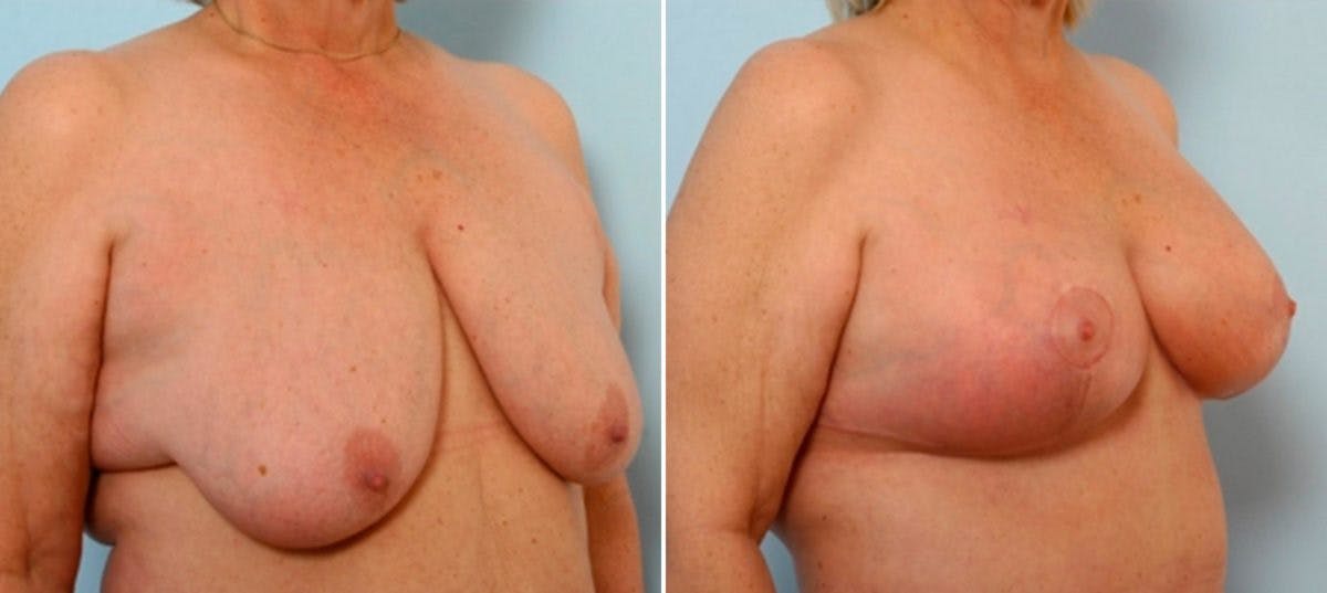 Breast Lift with Augmentation Before & After Gallery - Patient 55485021 - Image 2