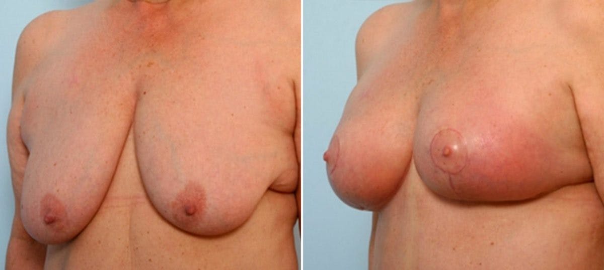 Breast Lift with Augmentation Before & After Gallery - Patient 55485021 - Image 4