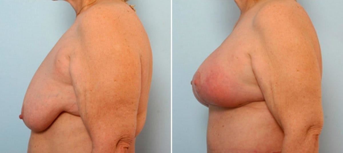 Breast Lift with Augmentation Before & After Gallery - Patient 55485021 - Image 5