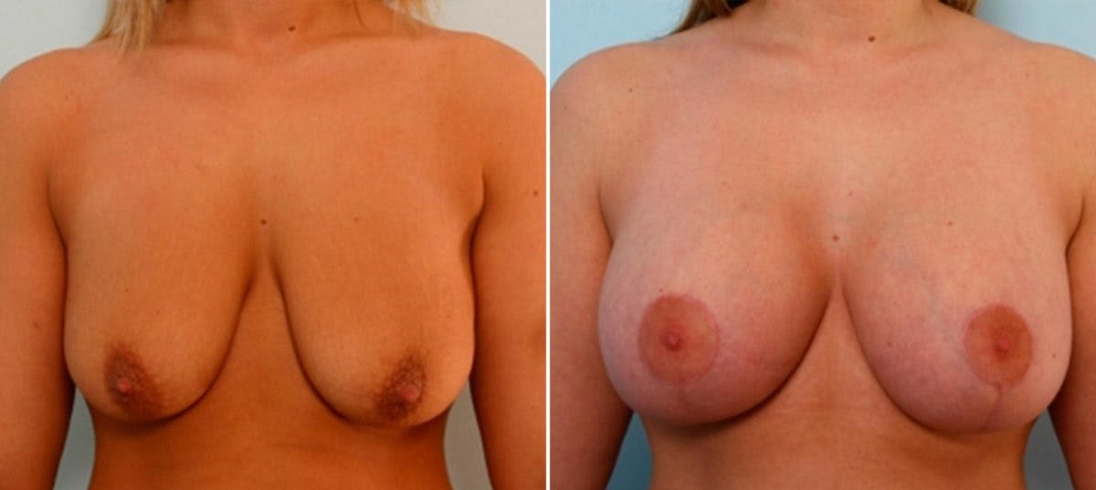 Breast Lift with Augmentation Before & After Gallery - Patient 55485022 - Image 1
