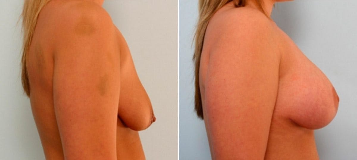 Breast Lift with Augmentation Before & After Photo - Patient 55485022 - Image 3