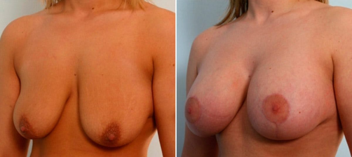 Breast Lift with Augmentation Before & After Photo - Patient 55485022 - Image 4