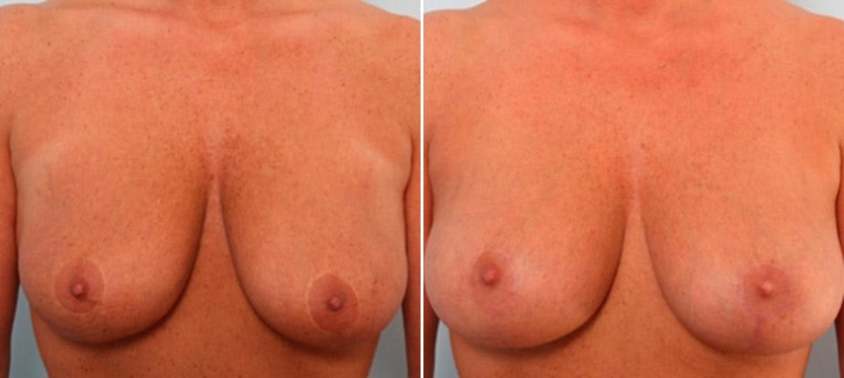 Breast Lift with Augmentation Before & After Gallery - Patient 55485023 - Image 1