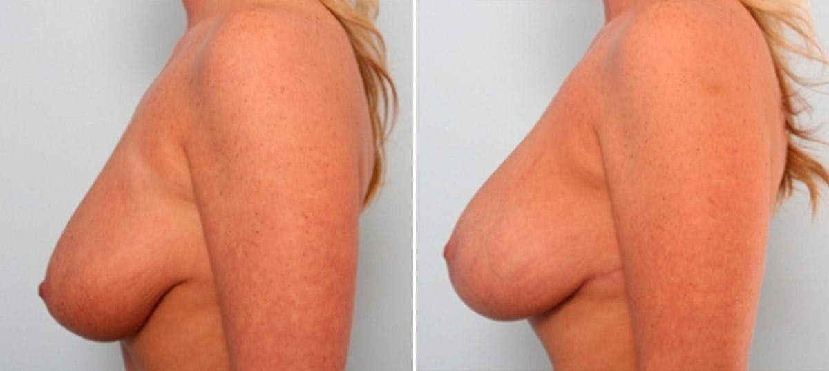 Breast Lift with Augmentation Before & After Gallery - Patient 55485023 - Image 5