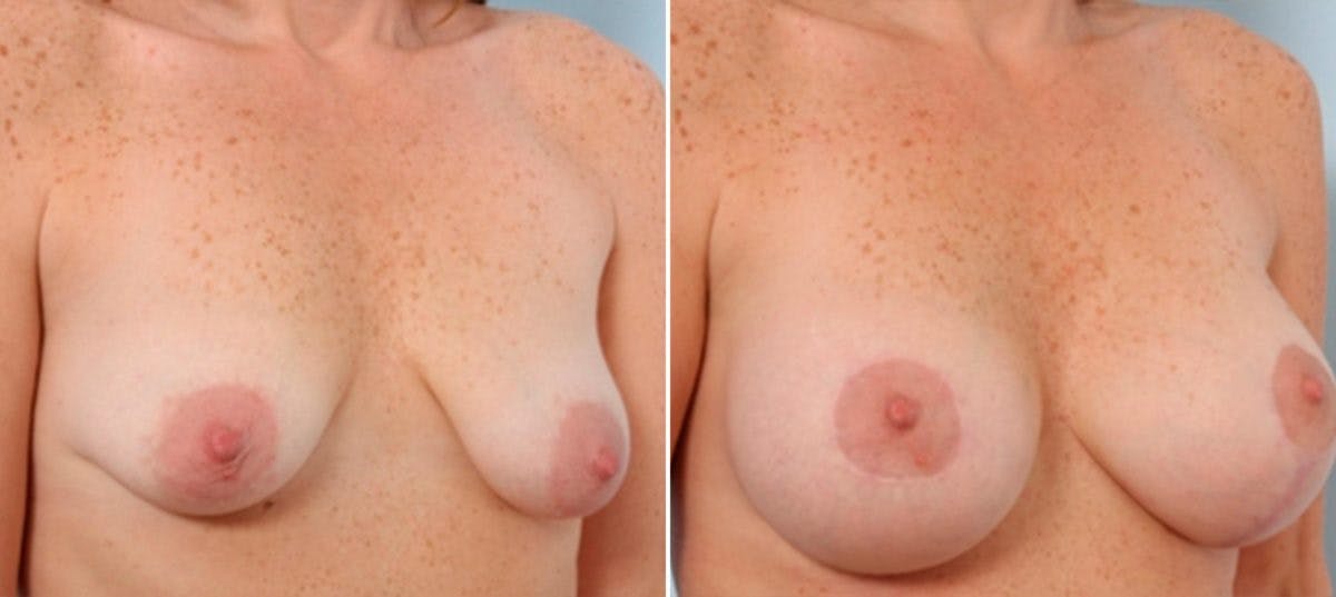Breast Lift with Augmentation Before & After Gallery - Patient 55485024 - Image 2