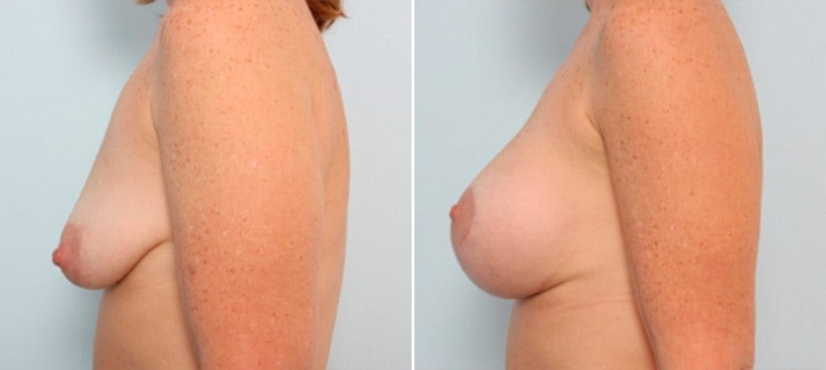 Breast Lift with Augmentation Before & After Gallery - Patient 55485024 - Image 5