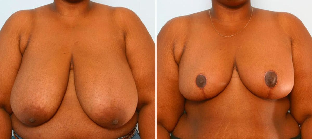 Breast Reduction Before & After Gallery - Patient 55078909 - Image 1