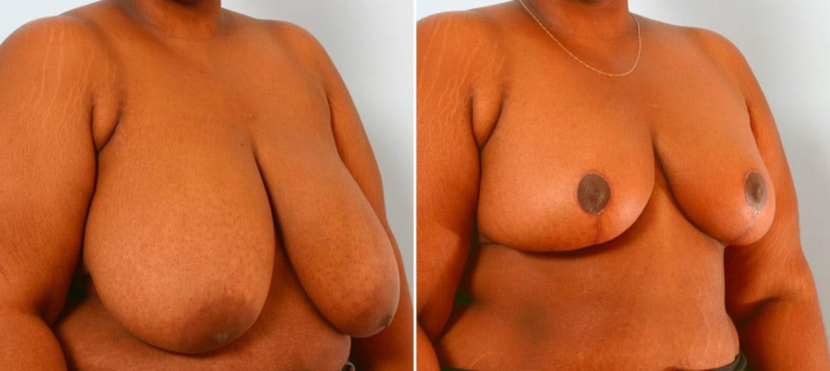 Breast Reduction Before & After Gallery - Patient 55078909 - Image 2