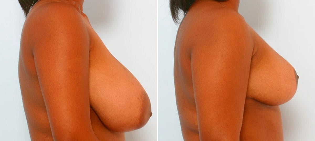 Breast Reduction Before & After Photo - Patient 55078910 - Image 3