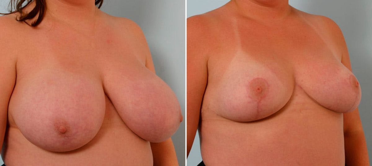 Breast Reduction Before & After Gallery - Patient 55078911 - Image 2