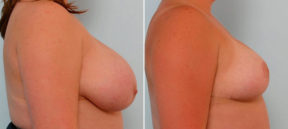 Breast Reduction Before & After Photo - Patient 55078911 - Image 3