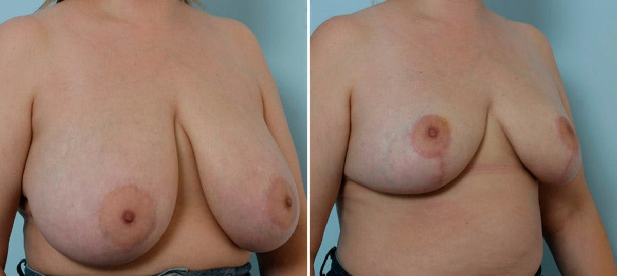 Breast Reduction Before & After Gallery - Patient 55078913 - Image 2