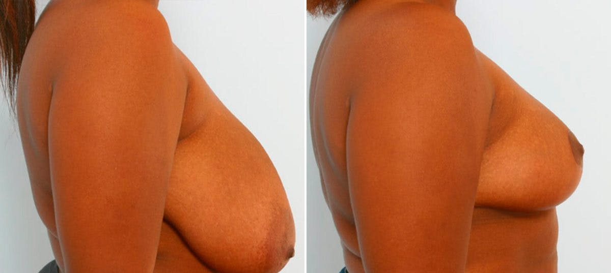 Breast Reduction Before & After Gallery - Patient 55078915 - Image 3