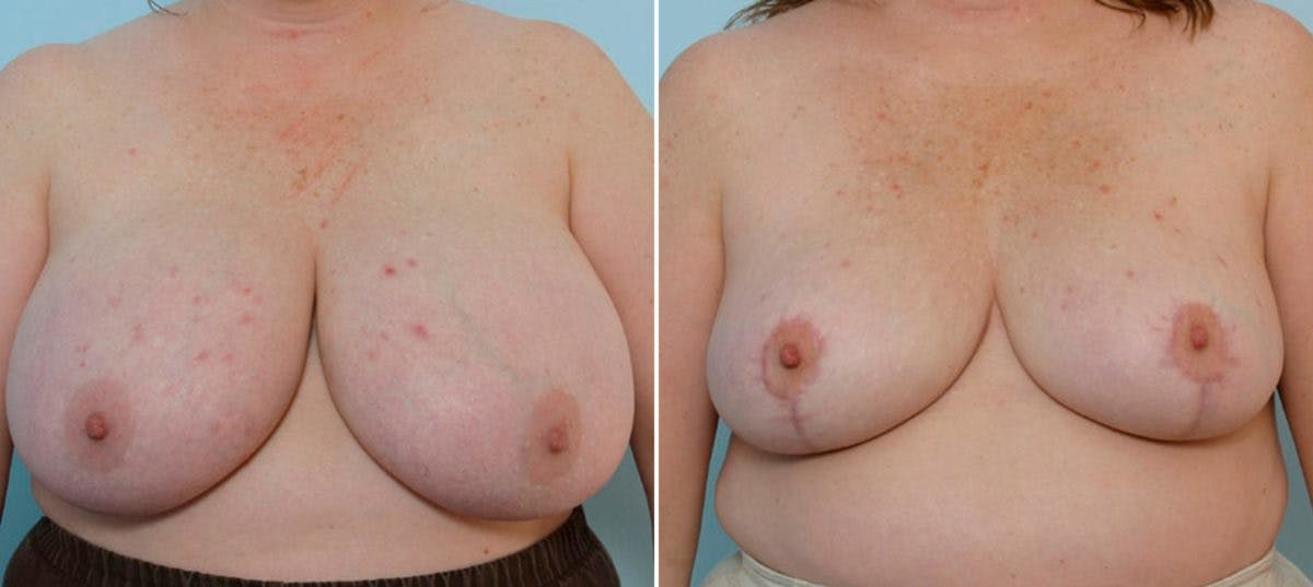 Breast Reduction Before & After Gallery - Patient 55078917 - Image 1