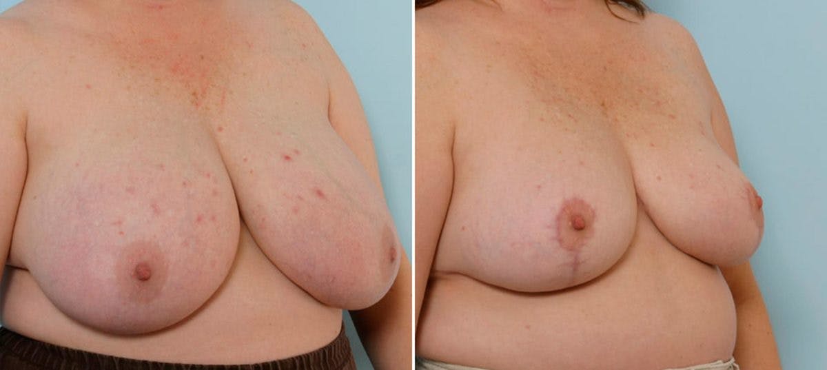 Breast Reduction Before & After Gallery - Patient 55078917 - Image 2