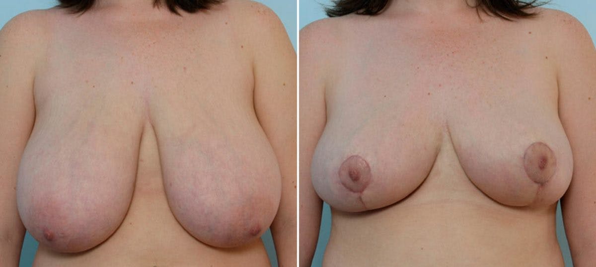 Breast Reduction Before & After Photo - Patient 55078918 - Image 1