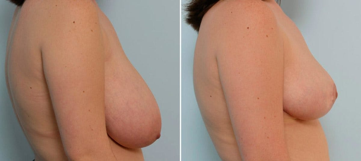 Breast Reduction Before & After Gallery - Patient 55078918 - Image 3