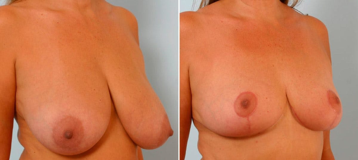 Breast Reduction Before & After Gallery - Patient 55078919 - Image 2