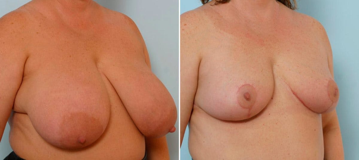 Breast Reduction Before & After Gallery - Patient 55078920 - Image 2