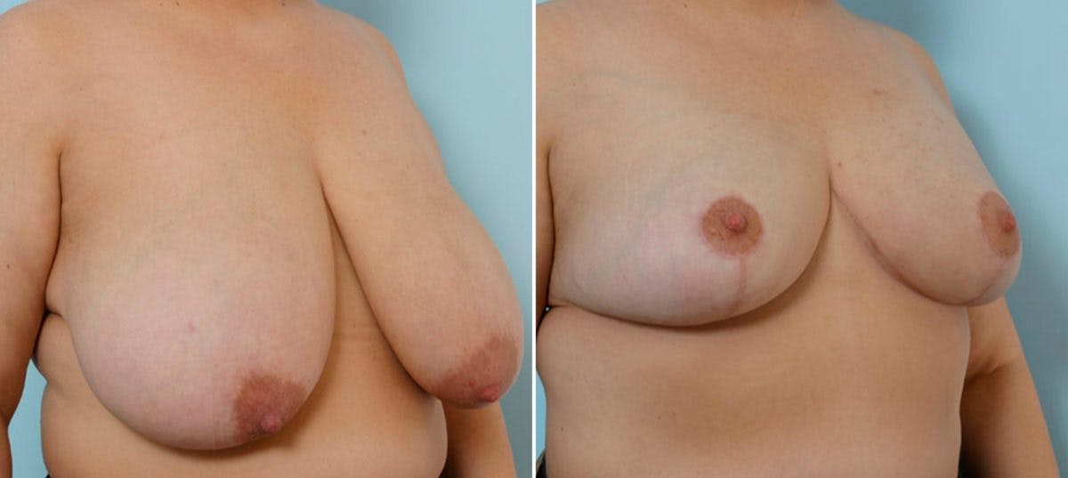 Breast Reduction Before & After Gallery - Patient 55078921 - Image 2
