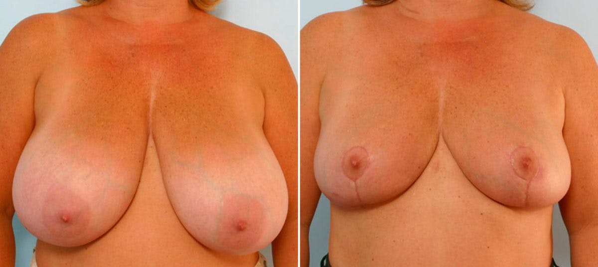 Breast Reduction Before & After Gallery - Patient 55078922 - Image 1