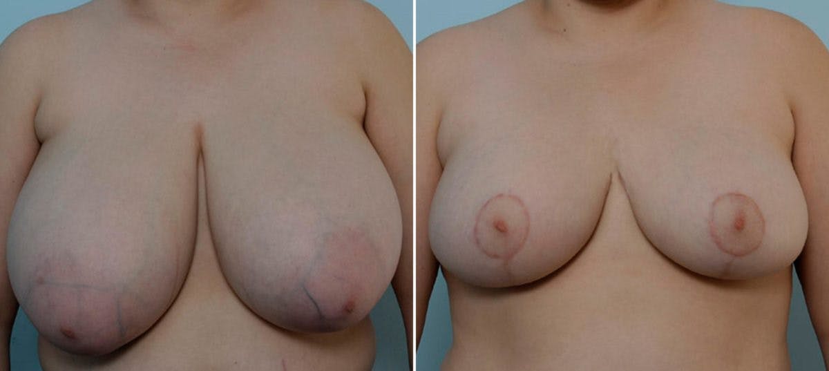 Breast Reduction Before & After Gallery - Patient 55078923 - Image 1