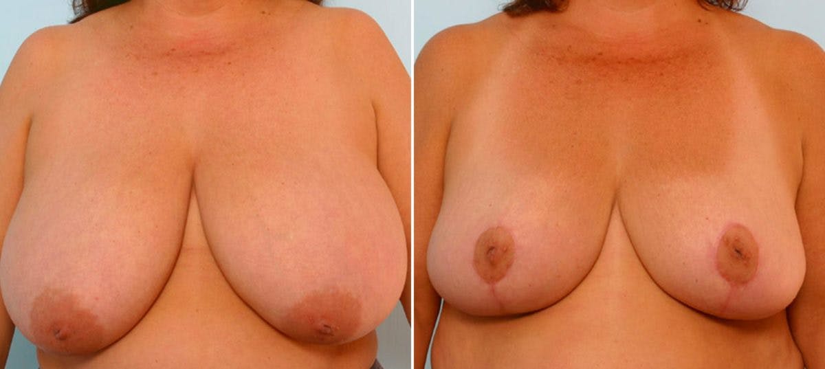 Breast Reduction Before & After Gallery - Patient 55078926 - Image 1