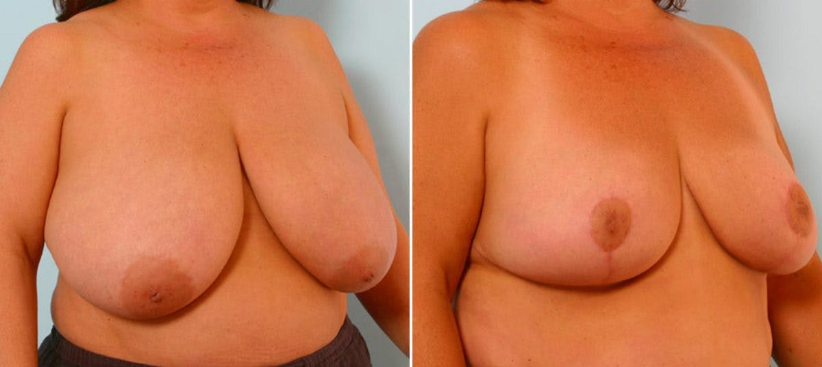 Breast Reduction Before & After Gallery - Patient 55078926 - Image 2