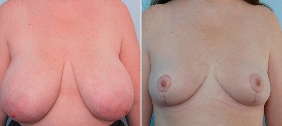 Breast Reduction Before & After Photo - Patient 55078928 - Image 1