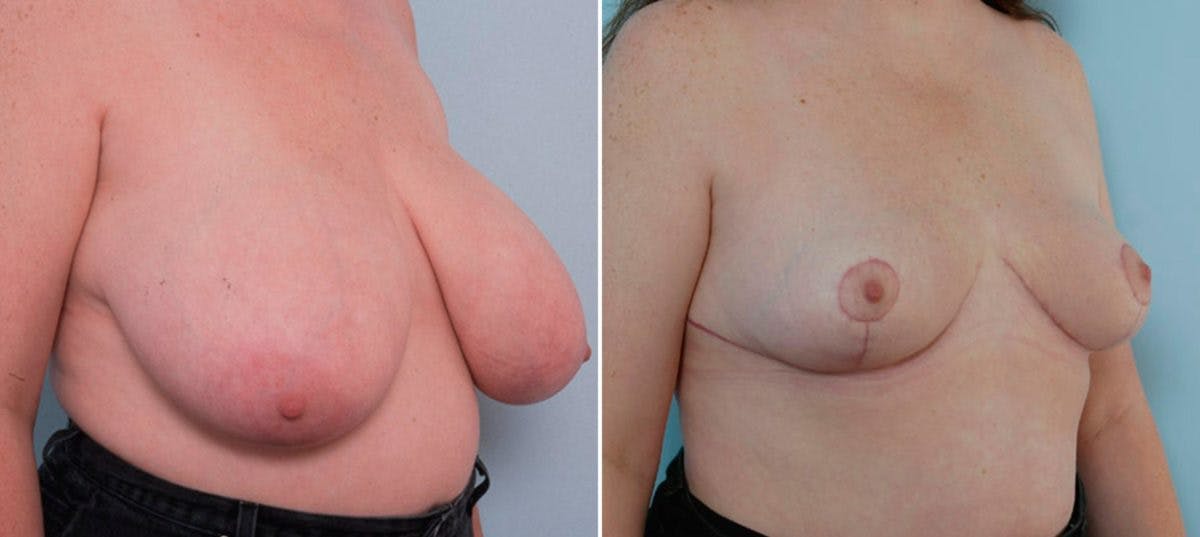Breast Reduction Before & After Gallery - Patient 55078928 - Image 2