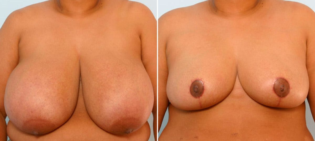 Breast Reduction Before & After Gallery - Patient 55078929 - Image 1