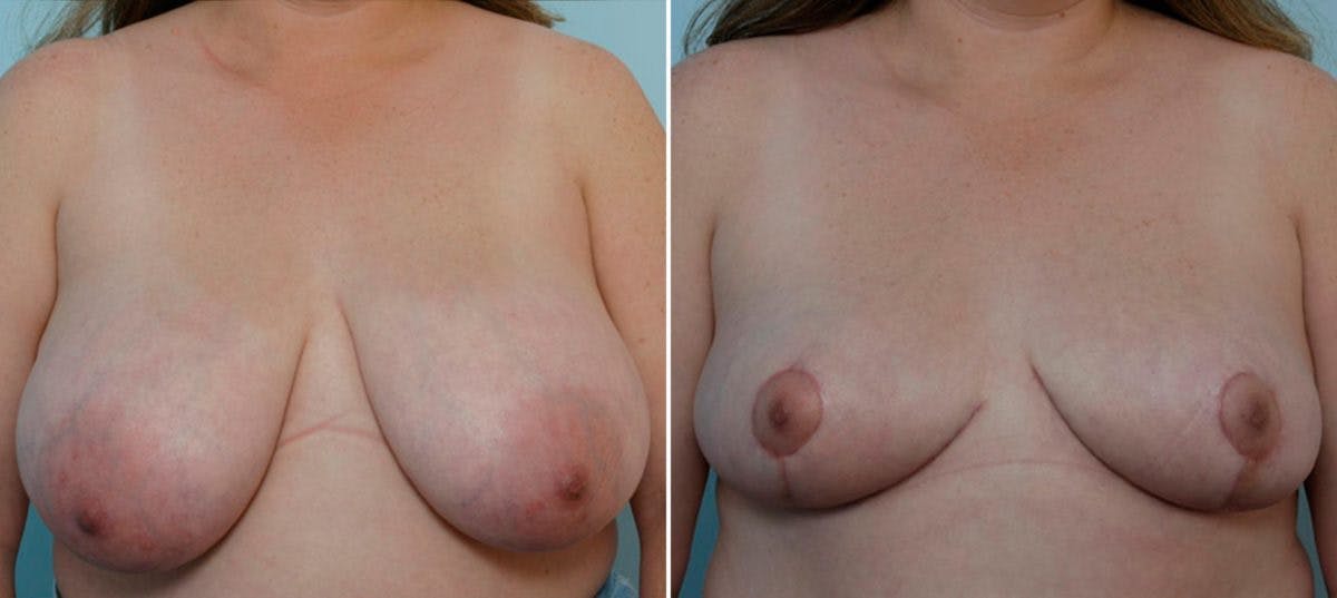 Breast Reduction Before & After Gallery - Patient 55078930 - Image 1