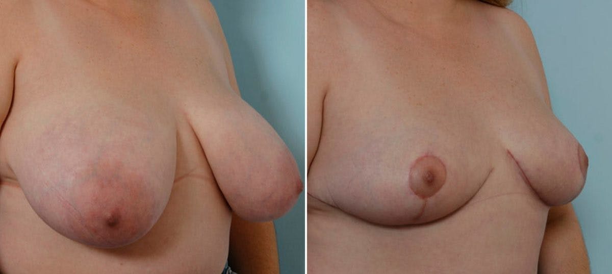 Breast Reduction Before & After Gallery - Patient 55078930 - Image 2