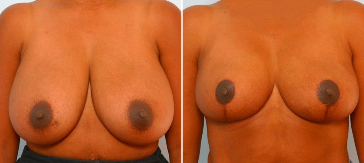 Breast Reduction Before & After Gallery - Patient 55078932 - Image 1