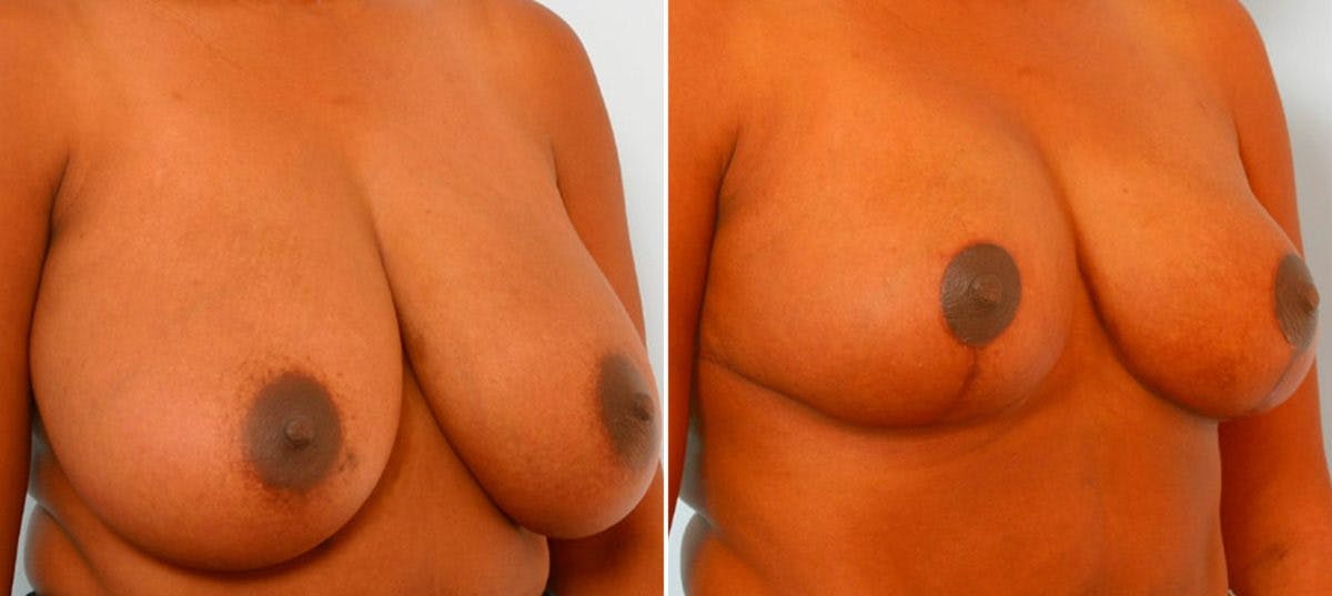 Breast Reduction Before & After Gallery - Patient 55078932 - Image 2