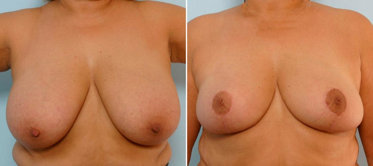 Breast Reduction Before & After Gallery - Patient 55078933 - Image 1