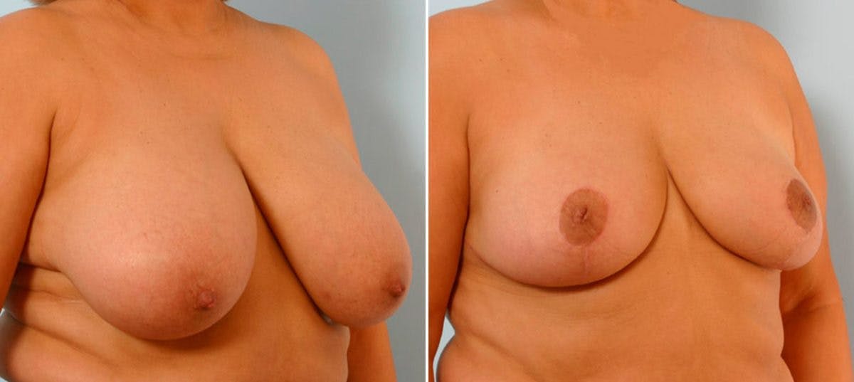 Breast Reduction Before & After Gallery - Patient 55078933 - Image 2