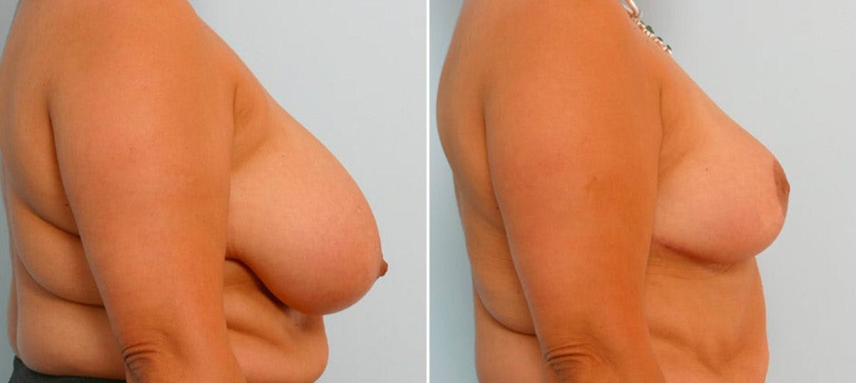 Breast Reduction Before & After Gallery - Patient 55078933 - Image 3
