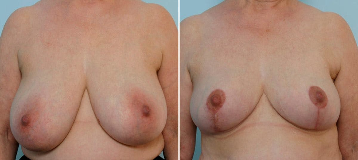 Breast Reduction Before & After Gallery - Patient 55078935 - Image 1
